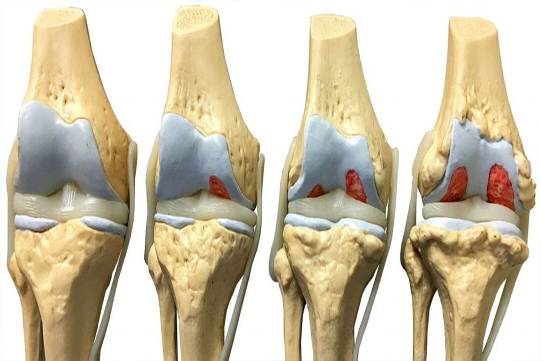 Stadien der Arthroseentwicklung