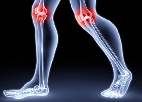 Die Gründe für die Entwicklung einer Knie -Arthrose