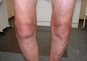 Wie man die Arthrose des Kniegelenks behandelt