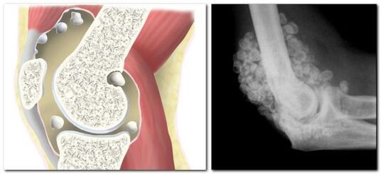 Chondromatose mit Schmerzen im Hüftgelenk.